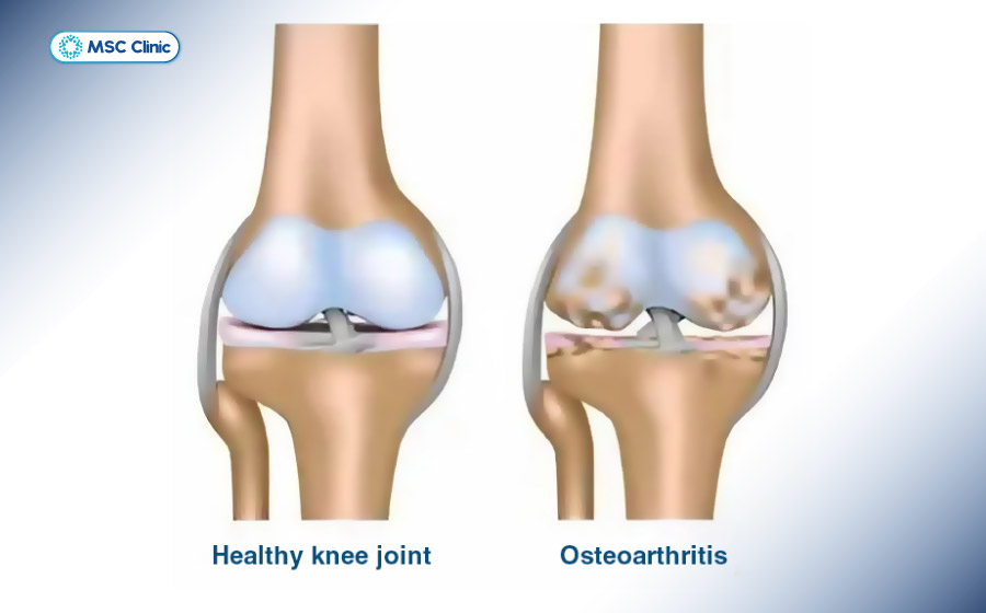 Lão hóa sụn khớp gối khiến sụn chêm trở nên mỏng, khô và giảm đàn hồi