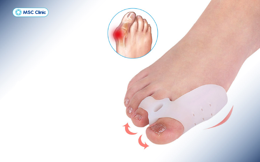 Người bệnh cần sử dụng miếng đệm trong trường hợp đau ngón chân cái do biến dạng nhẹ Người bệnh cần sử dụng miếng đệm trong trường hợp đau ngón chân cái do biến dạng nhẹ