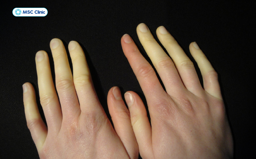 Người bị hội chứng Raynaud có đầu ngón tay đổi màu từ trắng sang tím rồi đỏ, gây đau nhói dữ dội