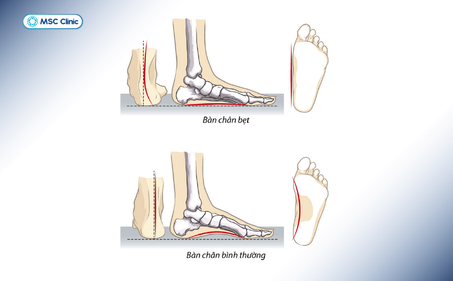 Người bị tình trạng bàn chân bẹt dễ gặp phải tê ngón chân cái