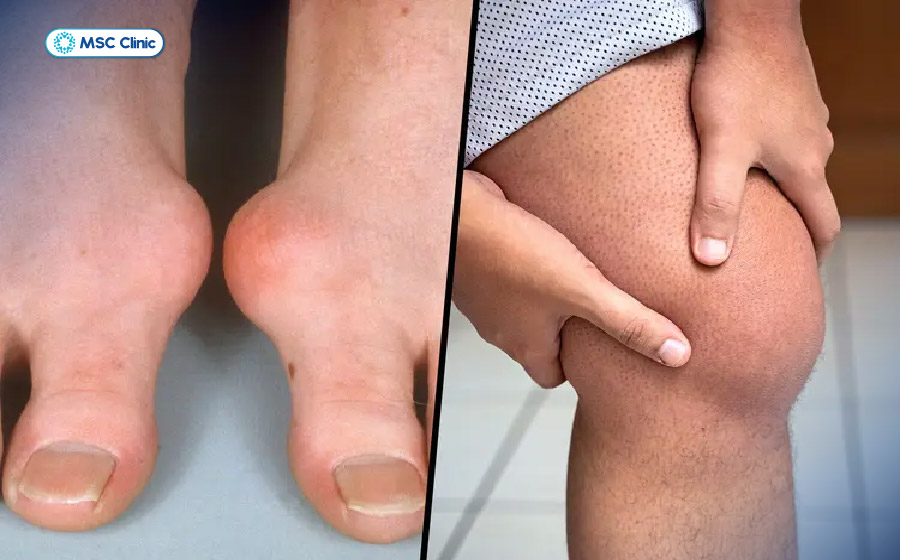 Người mắc gout có thể hồi phục chậm hơn do tình trạng viêm khớp kéo dài và tái phát nhiều lần