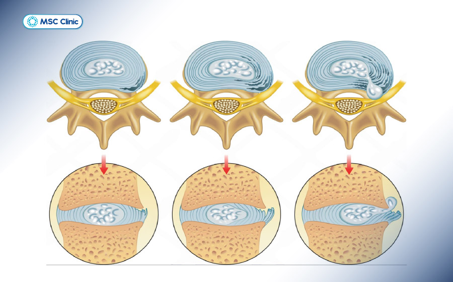 Phân loại rách bao xơ đĩa đệm theo hình thái tổn thương