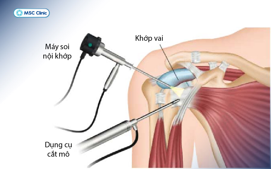 Phương pháp nội soi khớp vai để chẩn đoán những tổn thương phức tạp Phương pháp nội soi khớp vai để chẩn đoán những tổn thương phức tạp