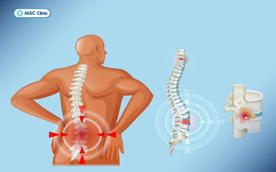 Rách bao xơ đĩa đệm tại cột sống thắt lưng là tình trạng phổ biến nhất