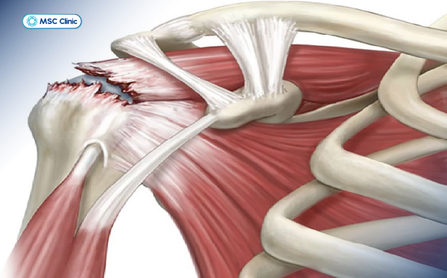 Rách gân cơ trên vai ảnh hưởng lớn tới khả năng vận động Rách gân cơ trên vai ảnh hưởng lớn tới khả năng vận động