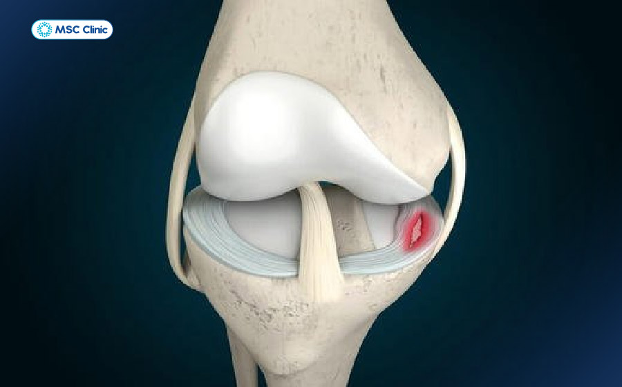 Rách sụn chêm kéo dài có thể làm giảm độ linh hoạt và độ vững của khớp gối