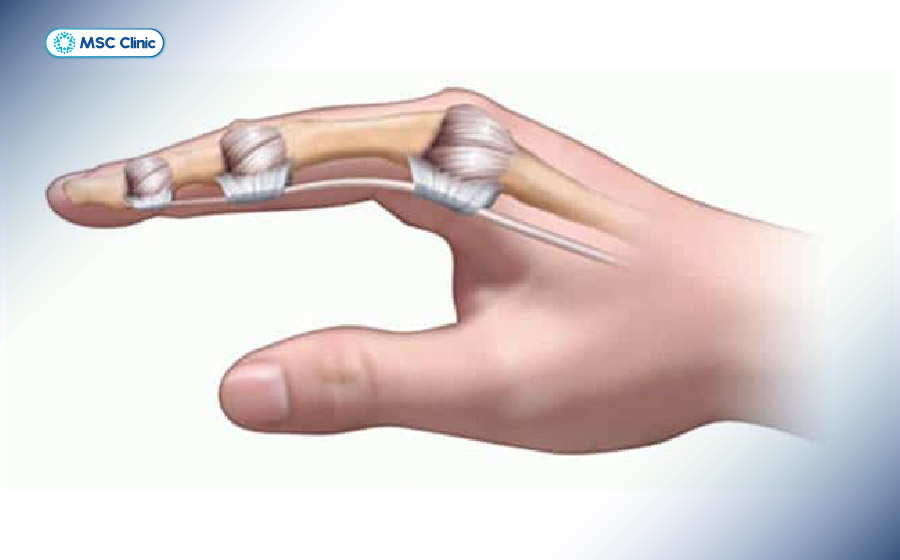 Sưng khớp ngón tay kéo dài có thể dẫn đến cứng khớp ngón tay và hạn chế vận động