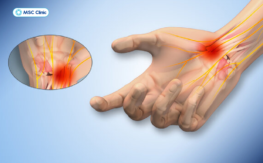 Tê tay xảy ra khi các dây thần kinh cảm giác bị chèn ép hoặc tổn thương từ cổ xuống tay