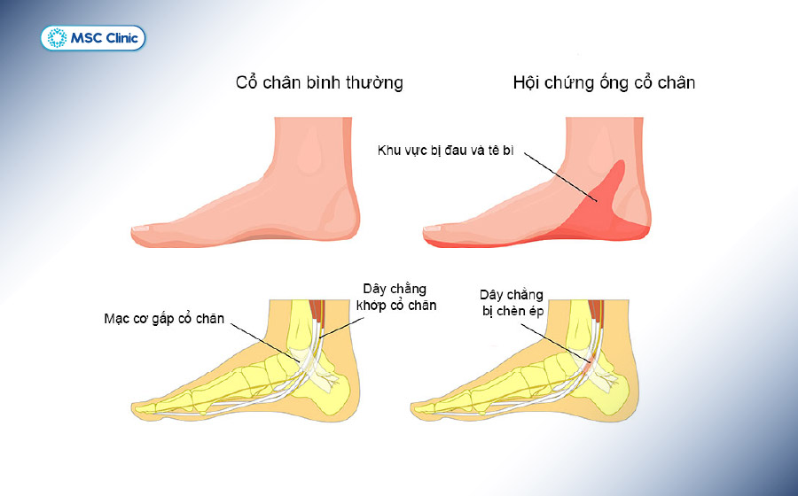 Theo thời gian, hội chứng ống cổ chân có thể làm teo cơ, khiến chân yếu đi rõ rệt 