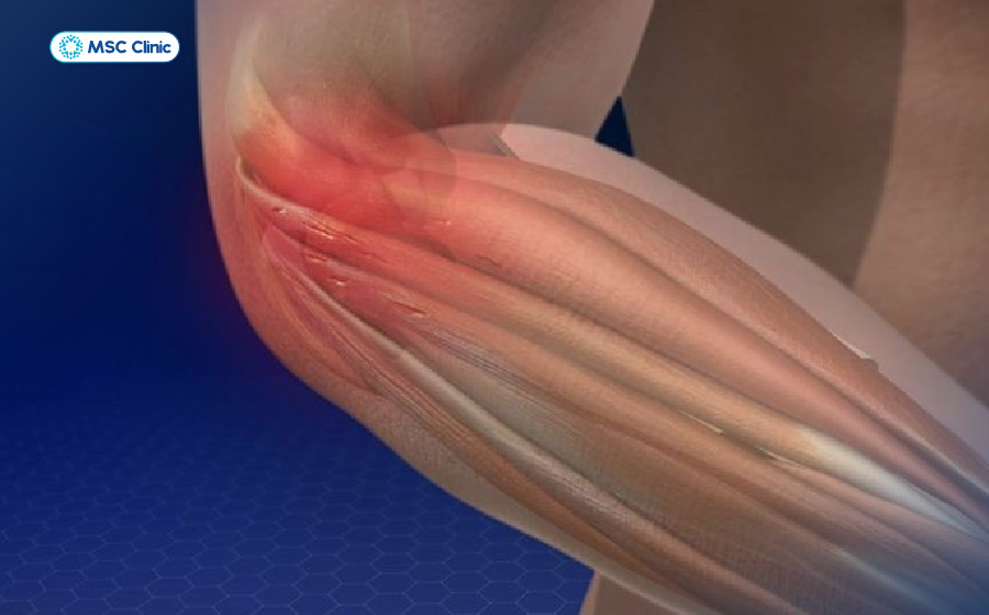 Thoái hóa khớp khiến khuỷu tay đau nhức và cứng khi vận động 