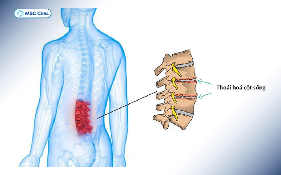 Thoái hóa là nguyên nhân phổ biến gây xẹp đĩa đệm cột sống Thoái hóa là nguyên nhân phổ biến gây xẹp đĩa đệm cột sống