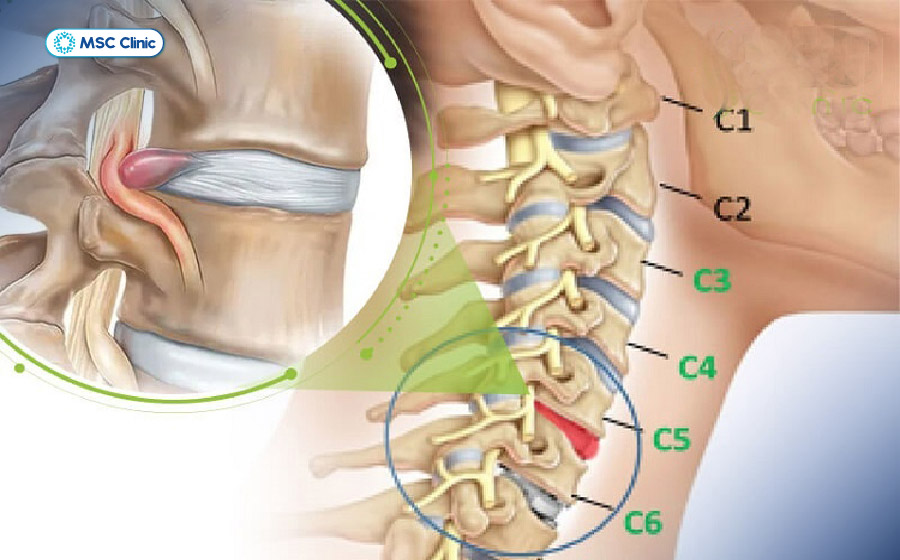 Thoát vị đĩa đệm cột sống cổ là nguyên nhân hàng đầu gây đau bả vai trái kèm tê bì tay