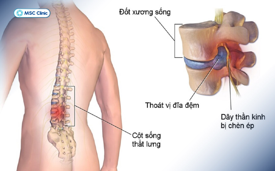 Thoát vị đĩa đệm thắt lưng gây tình trạng đau nhói khi cúi người