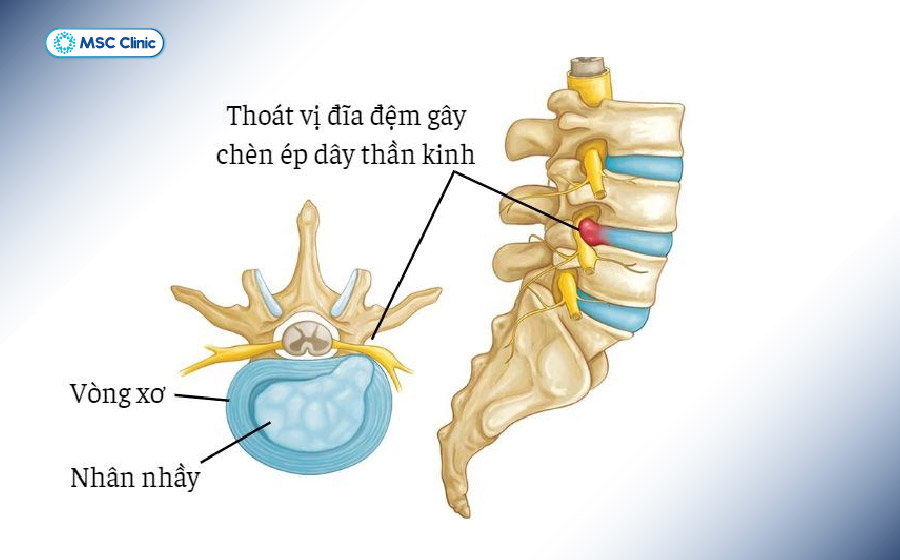 Thoát vị đĩa đệm xảy ra khi nhân nhầy bên trong đĩa đệm thoát ra ngoài và chèn ép vào rễ thần kinh
