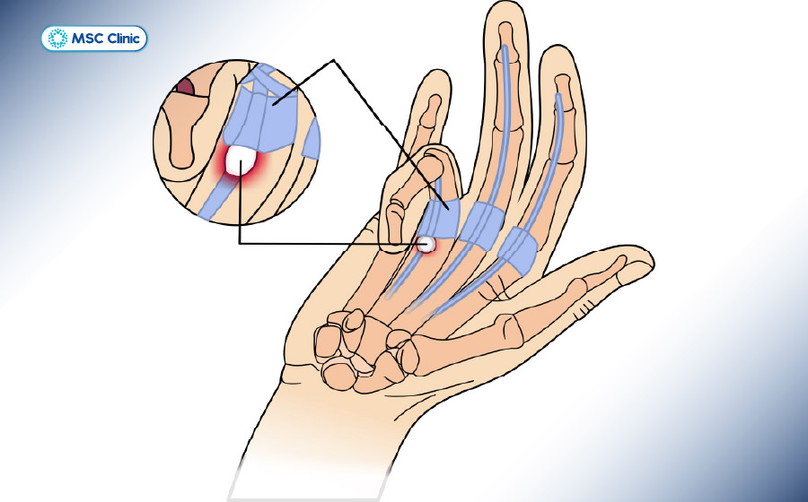 Tìm hiểu chi tiết ngón tay cò súng là gì trong bài viết dưới đây