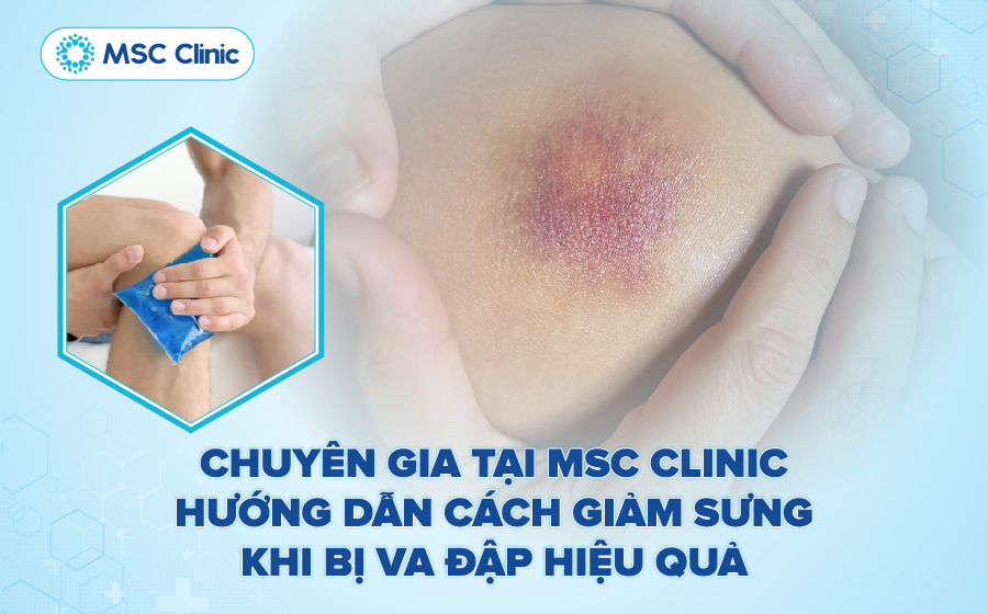 Tìm hiểu chi tiết về cách giảm sưng khi bị va đập trong bài viết sau 