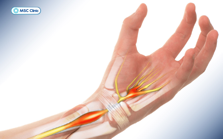 Tình trạng đau cổ tay gây đau nhức và khó chịu tại vùng khớp cổ tay Tình trạng đau cổ tay gây đau nhức và khó chịu tại vùng khớp cổ tay