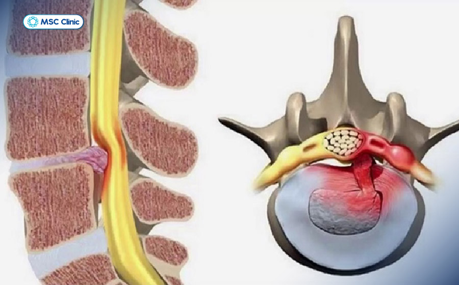Tình trạng rách bao xơ cần sớm được phát hiện và can thiệp điều trị