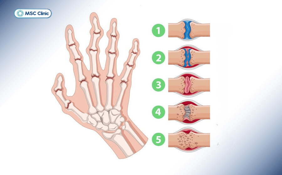 Tình trạng sưng khớp ngón tay có thể ảnh hưởng đáng kể đến sinh hoạt hàng ngày nếu không điều trị kịp thời