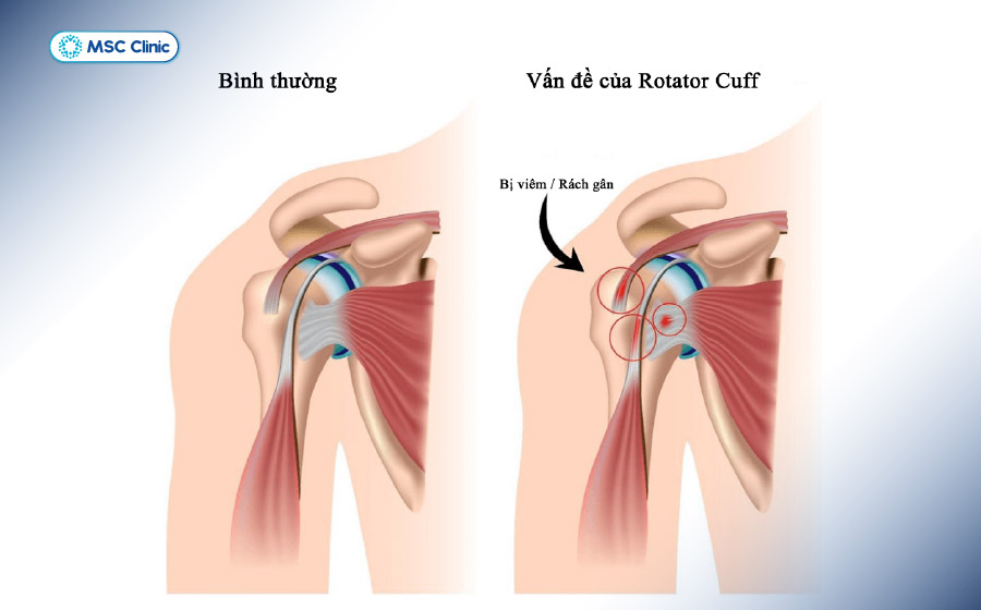 Tổn thương bao khớp, dây chằng có thể khiến khớp vai lỏng lẻo, làm tăng nguy cơ trật khớp vai