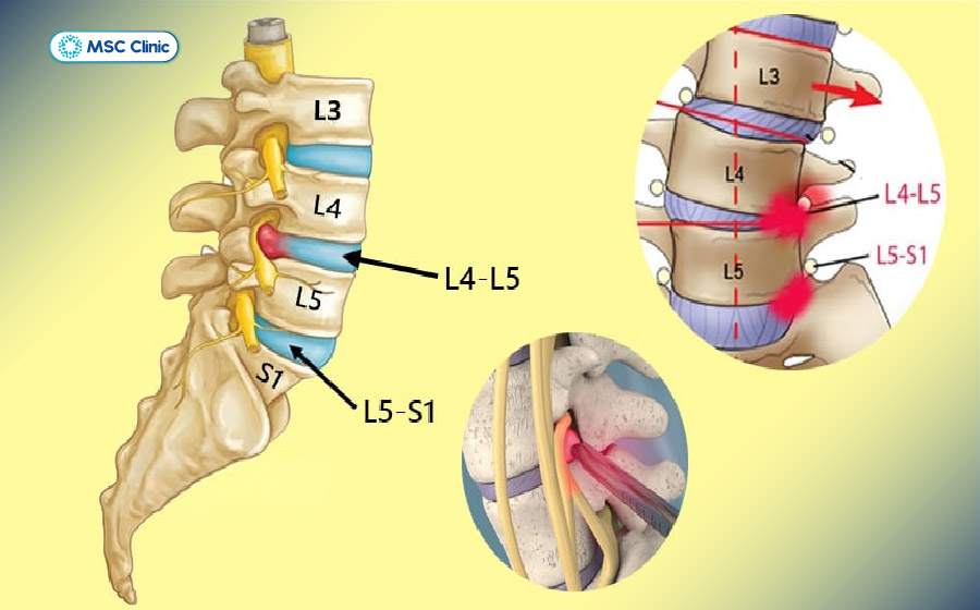 Vị trí ảnh hưởng của hội chứng thắt lưng hông Vị trí ảnh hưởng của hội chứng thắt lưng hông