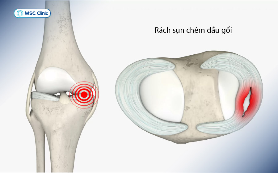 Vị trí rách sụn chêm đầu gối