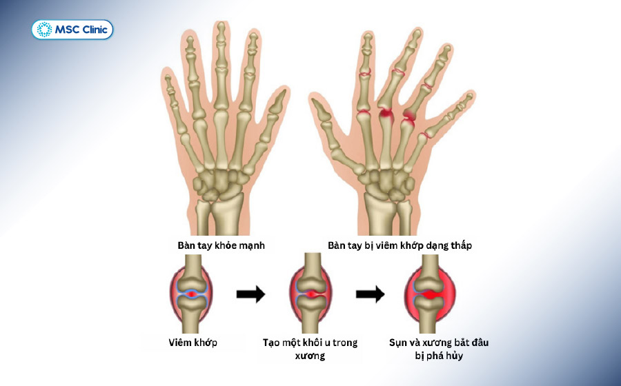 Viêm khớp dạng thấp gây cứng khớp ngón tay buổi sáng