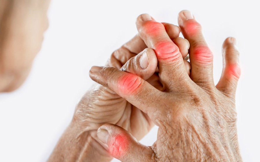 Viêm khớp dạng thấp gây viêm đau kéo dài tại nhiều khớp