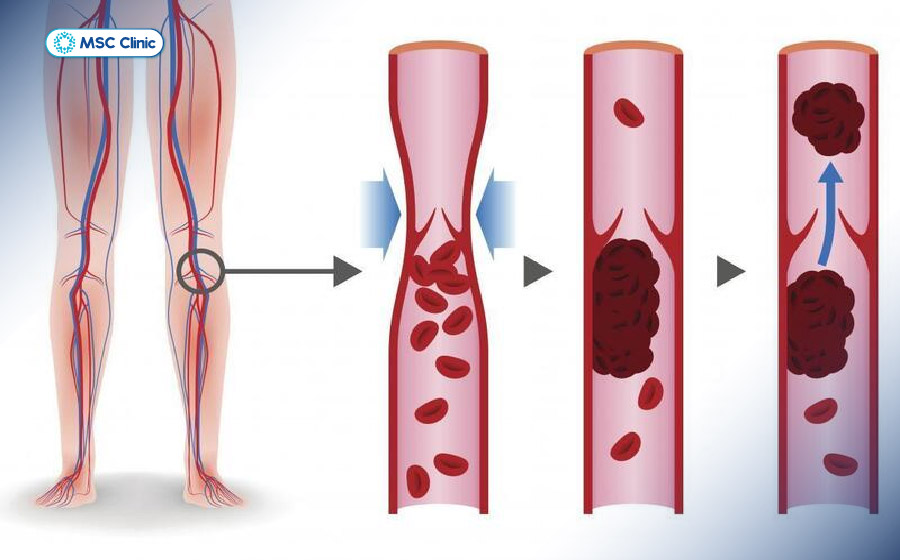 Viêm mạch máu gây cảm giác tê rần ở đầu chi như ngón cái