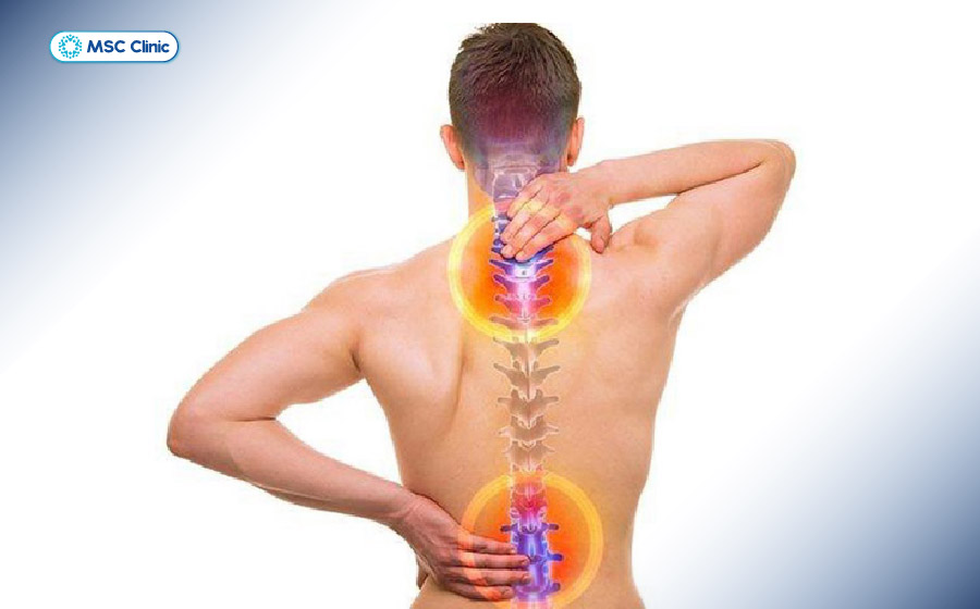 Vôi hóa cột sống có thể xảy ra ở nhiều vị trí như cổ, thắt lưng hay lưng trên Vôi hóa cột sống có thể xảy ra ở nhiều vị trí như cổ, thắt lưng hay lưng trên