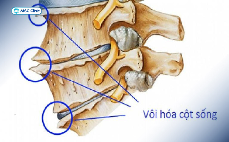 Vôi hóa cột sống dẫn đến bất thường tại cấu trúc xương Vôi hóa cột sống dẫn đến bất thường tại cấu trúc xương