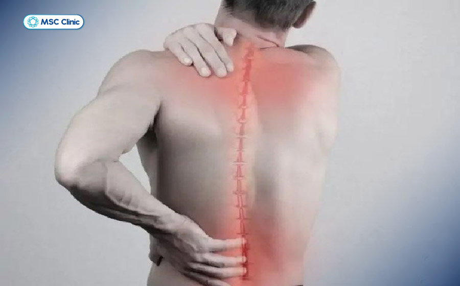 Vôi hóa cột sống gây đau và ảnh hưởng trực tiếp đến khả năng vận động của người bệnh Vôi hóa cột sống gây đau và ảnh hưởng trực tiếp đến khả năng vận động của người bệnh