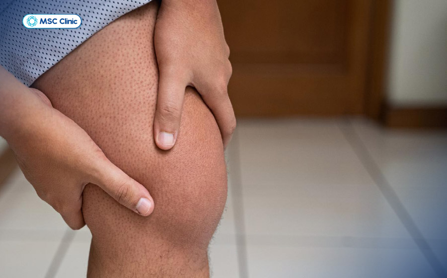 Vùng gối sưng to kèm cảm giác căng chặt nên đi khám bác sĩ sớm
