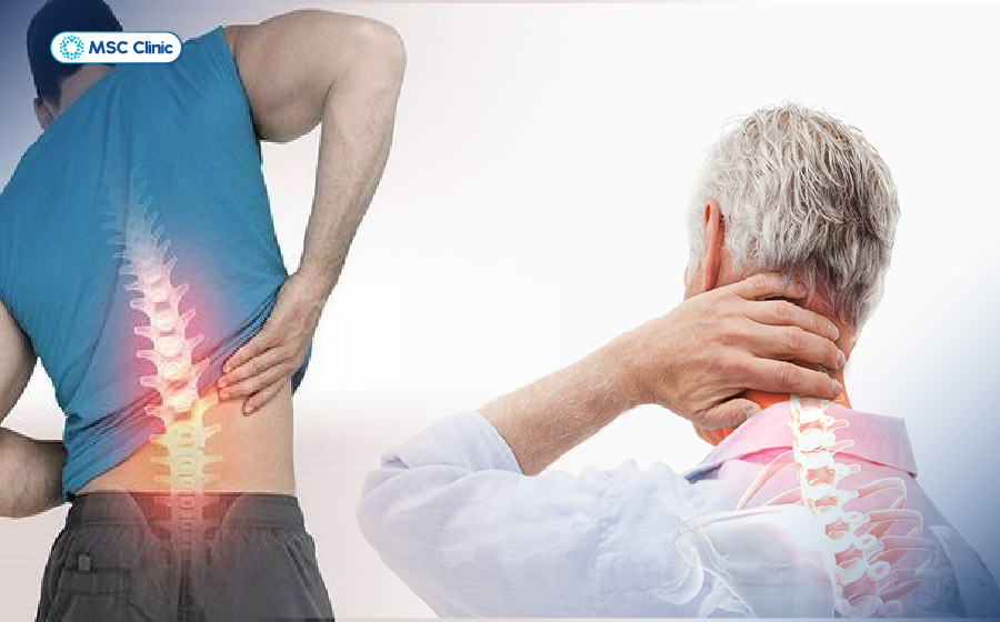 Xẹp đĩa đệm có thể gây đau cổ, đau lưng, tê bì tay chân và hạn chế vận động nếu chèn ép rễ thần kinh Xẹp đĩa đệm có thể gây đau cổ, đau lưng, tê bì tay chân và hạn chế vận động nếu chèn ép rễ thần kinh
