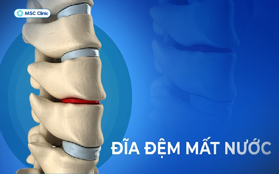 Xẹp đĩa đệm cột sống xảy ra khi đĩa đệm mất nước, giảm chiều cao và giảm khả năng hấp thụ lực giữa các đốt sống Xẹp đĩa đệm cột sống xảy ra khi đĩa đệm mất nước, giảm chiều cao và giảm khả năng hấp thụ lực giữa các đốt sống