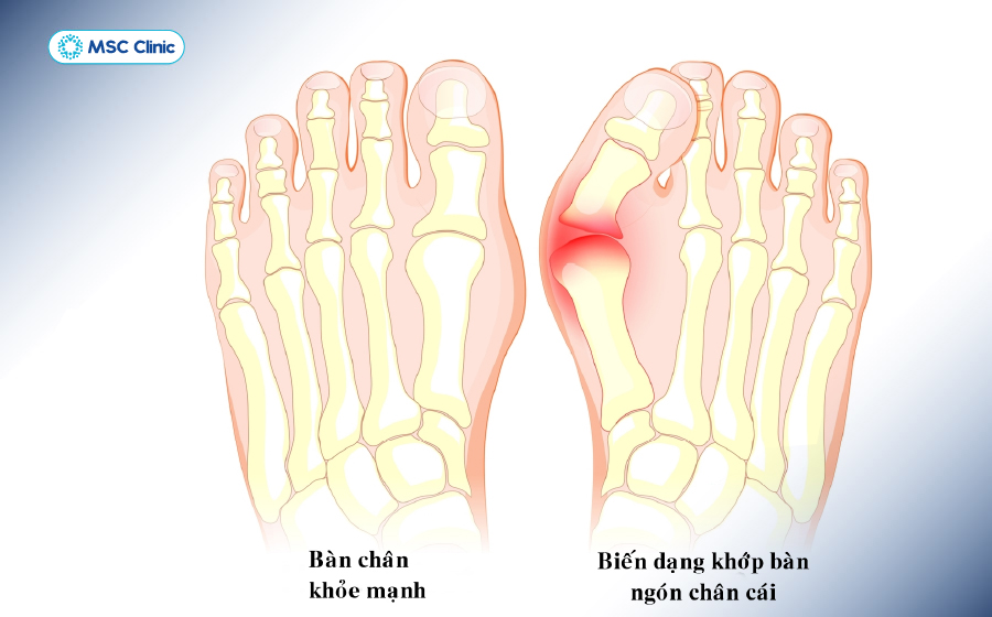 Xương ngón chân cái bị biến dạng Xương ngón chân cái bị biến dạng