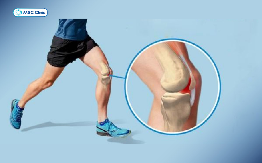 Chạy bộ quá sức có thể làm tăng áp lực lên khớp bánh chè - đùi, gây đau mỏi khớp gối ở người trẻ tuổi Chạy bộ quá sức có thể làm tăng áp lực lên khớp bánh chè - đùi, gây đau mỏi khớp gối ở người trẻ tuổi