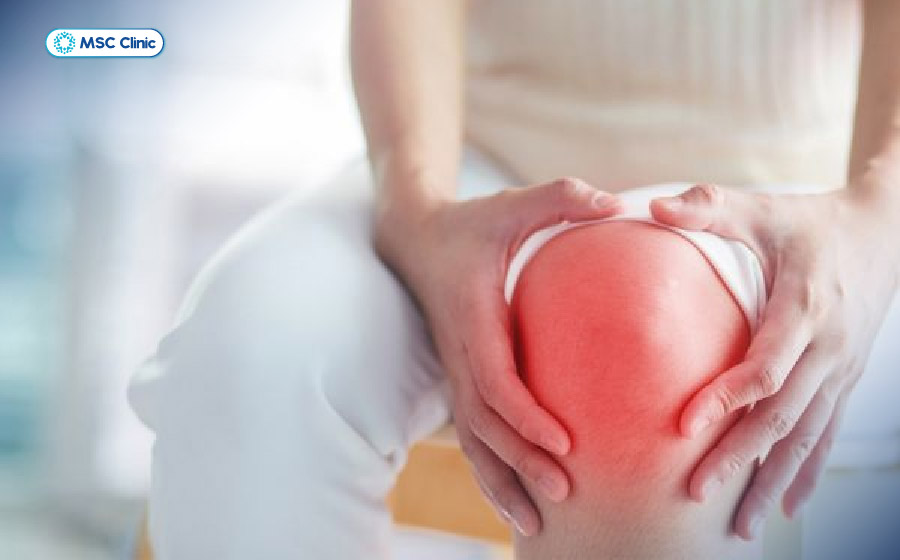 Sưng, cứng khớp là những dấu hiệu cần chú ý khi bị mỏi khớp gối kéo dài Sưng, cứng khớp là những dấu hiệu cần chú ý khi bị mỏi khớp gối kéo dài