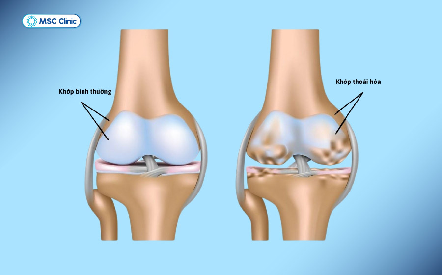 Thoái hóa khớp gối sớm có thể xuất hiện ở người trẻ từng chấn thương, thừa cân hoặc vận động quá tải kéo dài Thoái hóa khớp gối sớm có thể xuất hiện ở người trẻ từng chấn thương, thừa cân hoặc vận động quá tải kéo dài