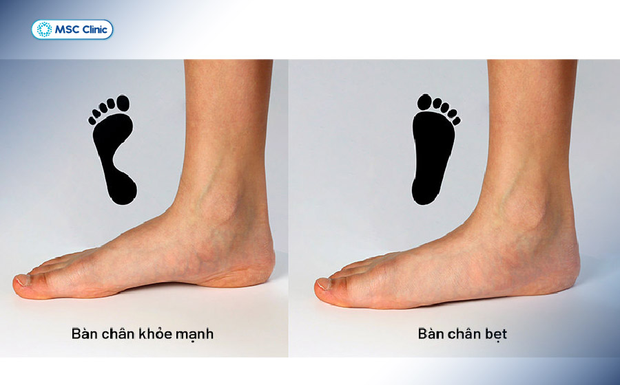 Bàn chân bẹt và các bất thường cơ học bàn chân có thể làm tăng áp lực lên dây thần kinh vùng cổ chân Bàn chân bẹt và các bất thường cơ học bàn chân có thể làm tăng áp lực lên dây thần kinh vùng cổ chân