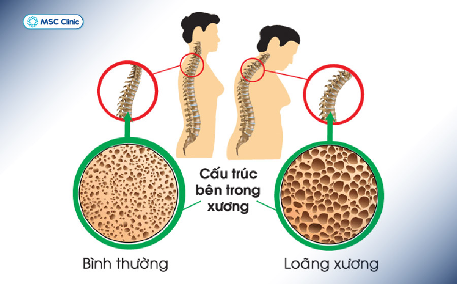 Bệnh loãng xương thường tiến triển thầm lặng trong thời gian dài mà không có triệu chứng rõ rệt