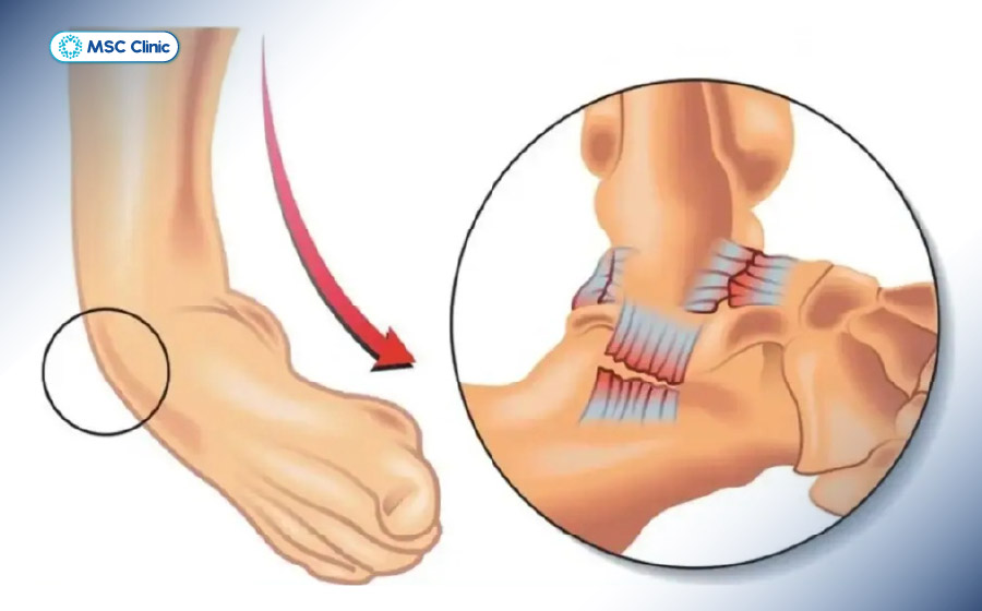 Bong gân ảnh hưởng đến phần dây chằng, không gây ra gãy xương Bong gân ảnh hưởng đến phần dây chằng, không gây ra gãy xương