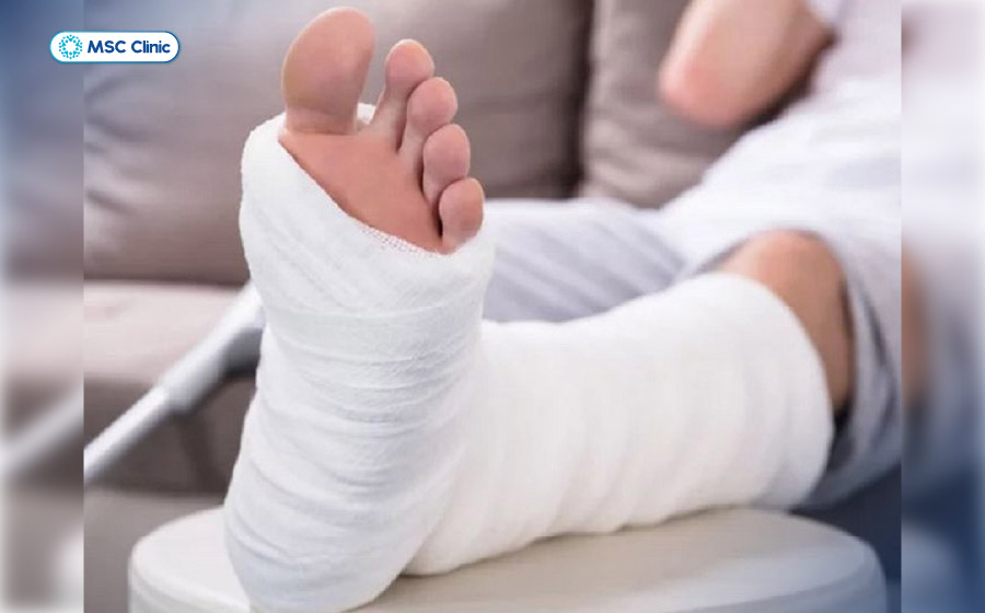 Bột cố định mắt cá chân giúp tạo điều kiện thuận lợi cho quá trình liền xương Bột cố định mắt cá chân giúp tạo điều kiện thuận lợi cho quá trình liền xương