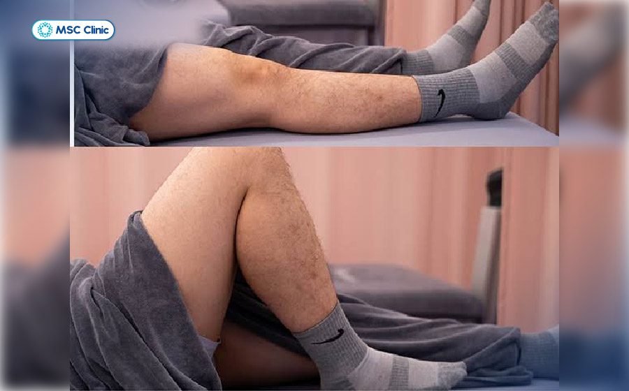 Các bài tập phục hồi chức năng giúp cải thiện tầm vận động và giảm nguy cơ cứng khớp gối