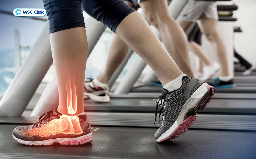 Các hoạt động áp lực lên cổ chân như tham gia hoạt động thể chất khiến triệu chứng rõ rệt hơn Các hoạt động áp lực lên cổ chân như tham gia hoạt động thể chất khiến triệu chứng rõ rệt hơn