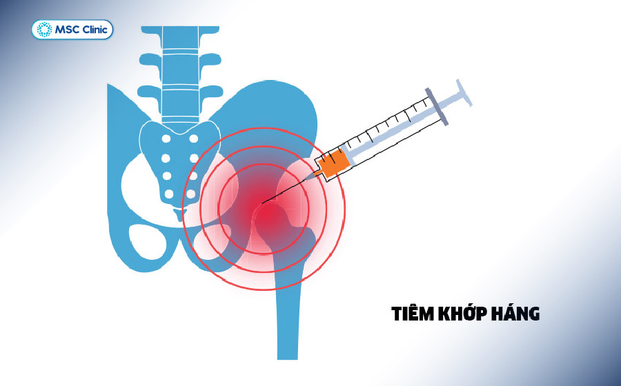 Các phương pháp hỗ trợ phục hồi mô đang được nghiên cứu và ứng dụng trong điều trị nhiều bệnh lý cơ xương khớp Các phương pháp hỗ trợ phục hồi mô đang được nghiên cứu và ứng dụng trong điều trị nhiều bệnh lý cơ xương khớp