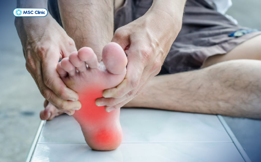 Căng cơ lòng bàn chân có thể xảy ra do nhiều nguyên nhân khác nhau Căng cơ lòng bàn chân có thể xảy ra do nhiều nguyên nhân khác nhau