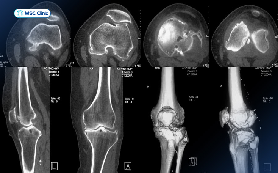 Chụp CT khớp gối phát hiện nhanh các trường hợp gãy xương Chụp CT khớp gối phát hiện nhanh các trường hợp gãy xương