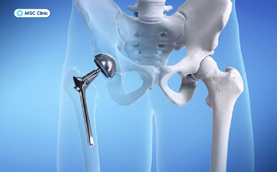 Chụp MRI có hại không thì với người có khớp nhân tạo cần có sự đồng ý của bác sĩ chuyên khoa Chụp MRI có hại không thì với người có khớp nhân tạo cần có sự đồng ý của bác sĩ chuyên khoa