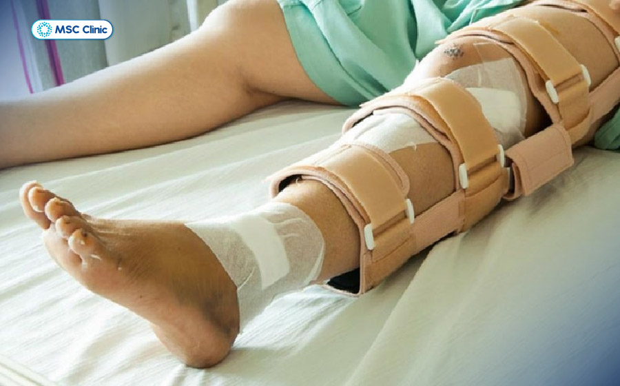 Cố định chân ở tư thế phù hợp giúp hạn chế nguy cơ di lệch ổ gãy trước khi đến cơ sở y tế 